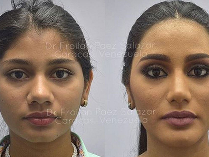 صور للوصيفة الثانية لملكة جمال الكون قبل وبعد عمليات التجميل!